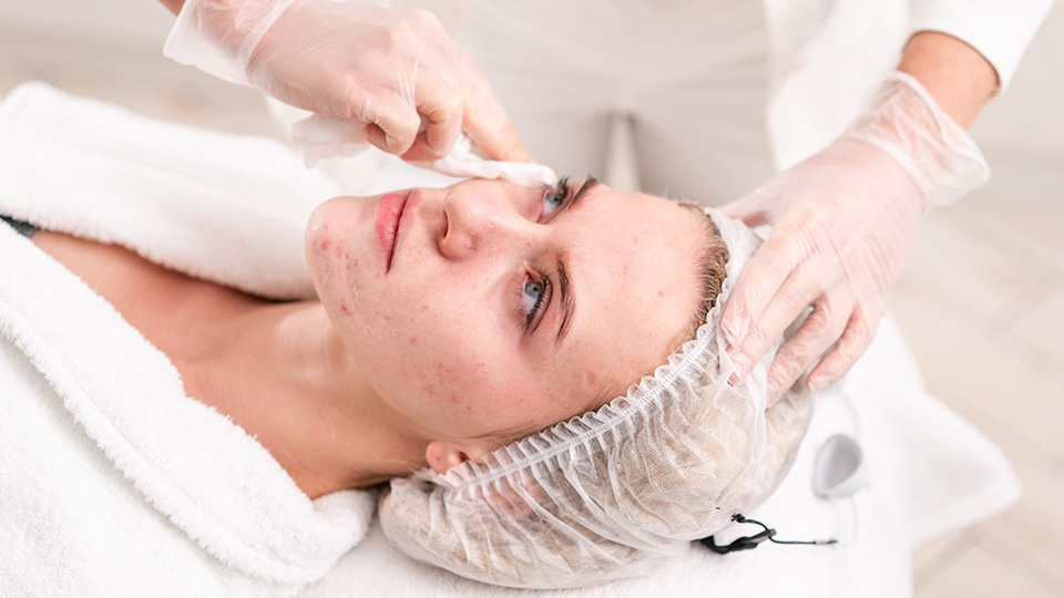 Acne Treatment image