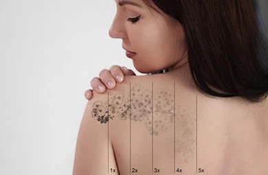 tattoo-removal image